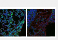 研究人员发现在肺纤维化中发挥作用的蛋白质传感器